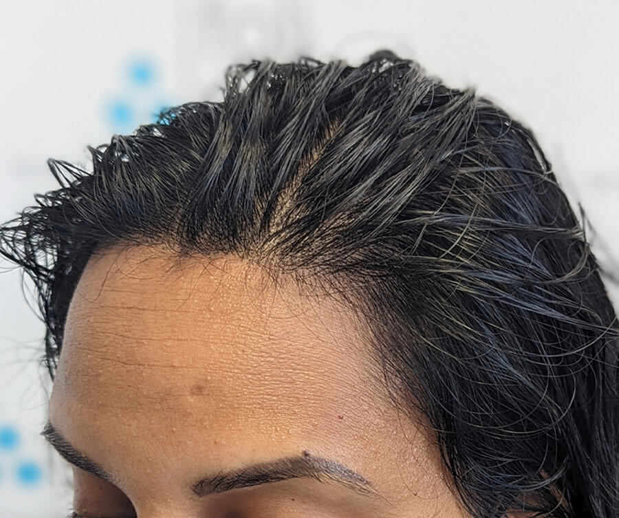 Hairline tattoo result 4