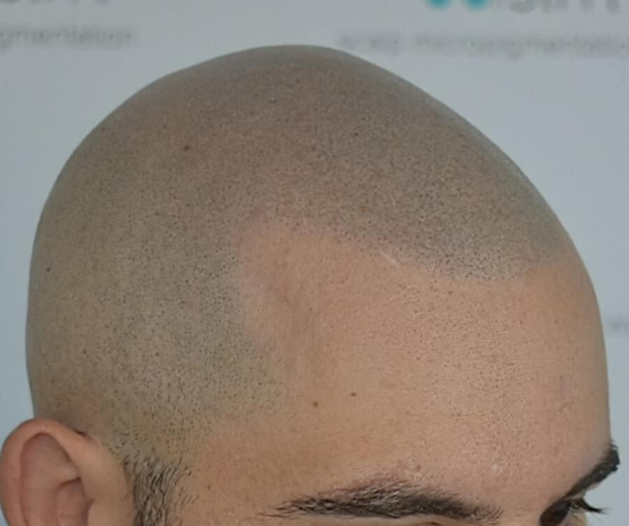 Hairline tattoo result 3