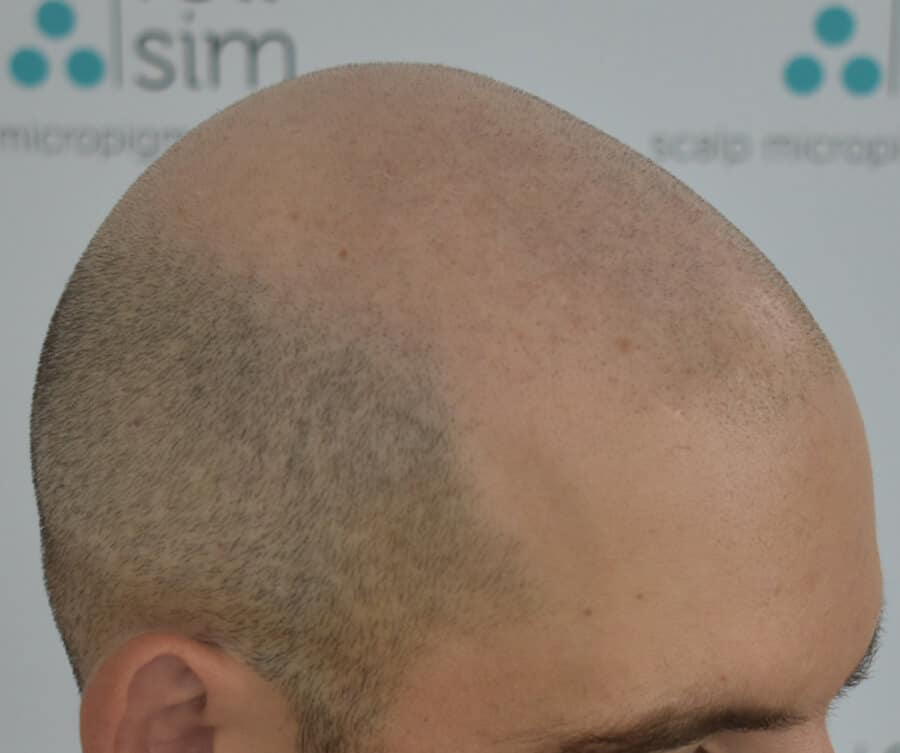 Hairline before 3