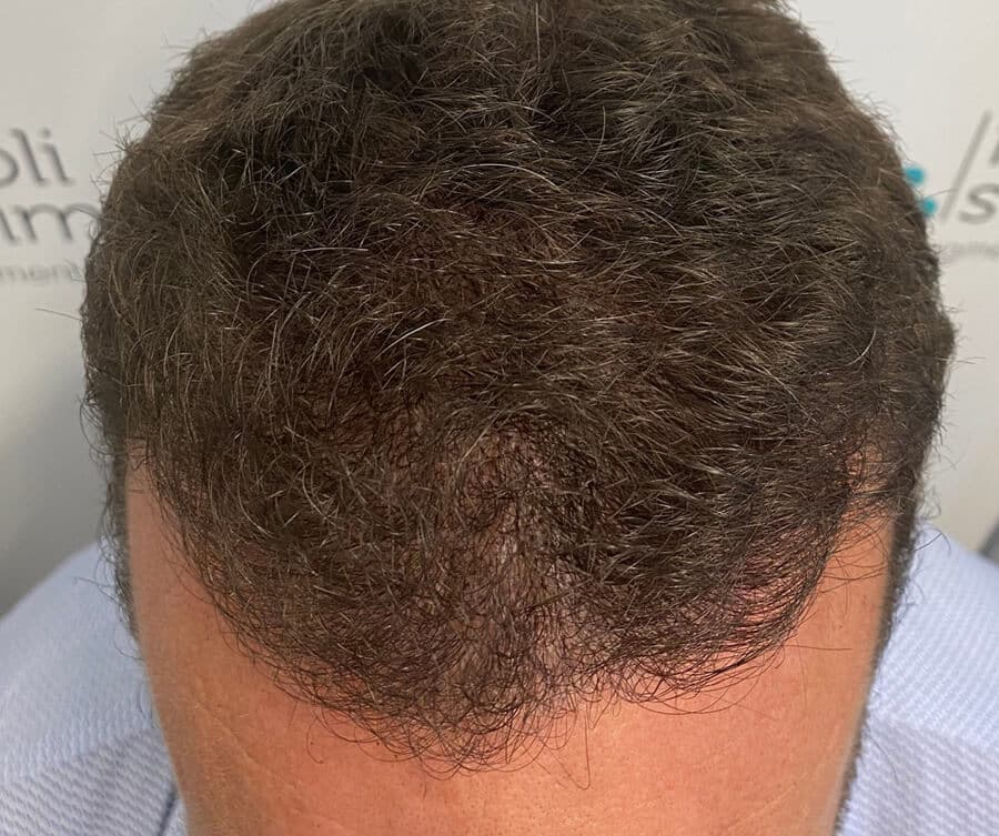 Hairline tattoo result 2