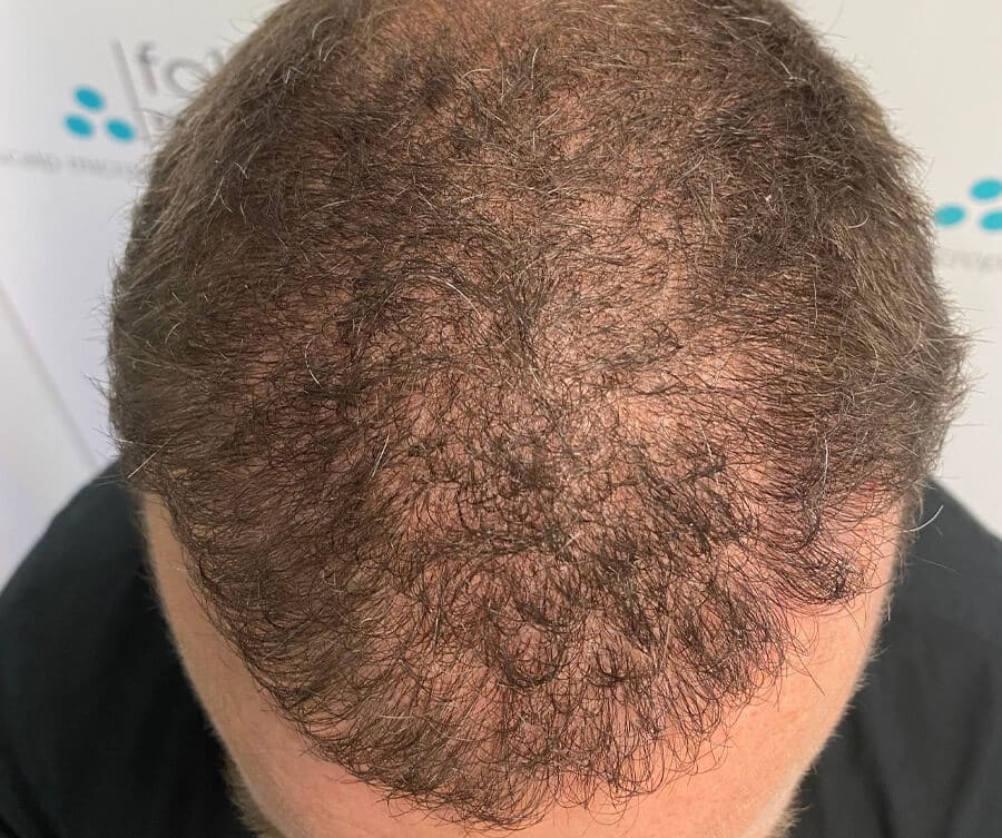 Hairline before 2