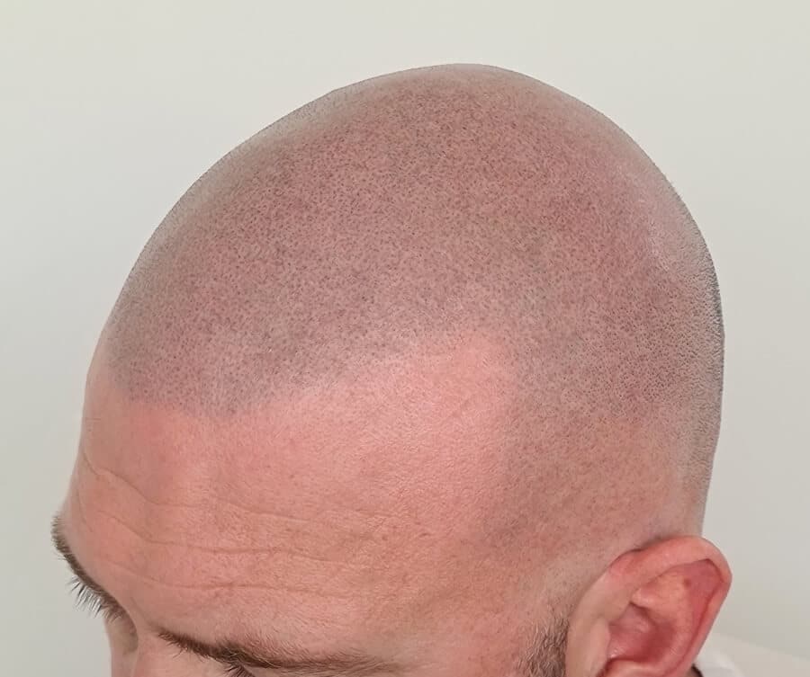Hairline tattoo result 1