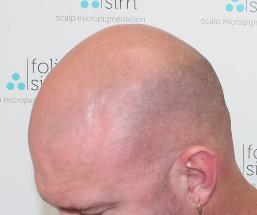 Hairline before 1