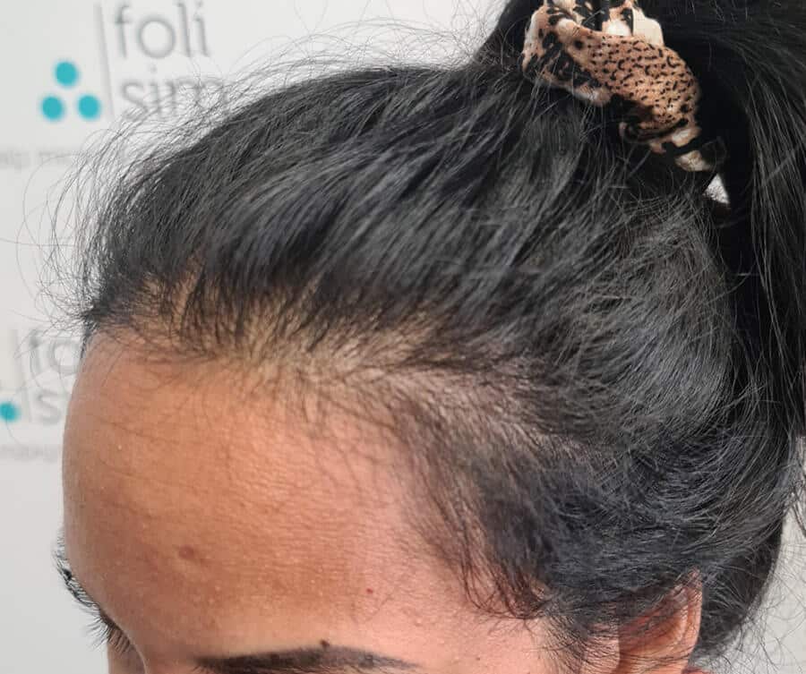 Hairline before 4