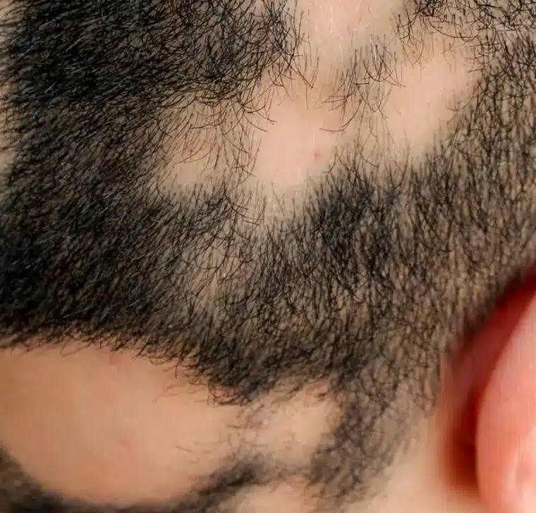 Are Hair Loss Treatments Safe?