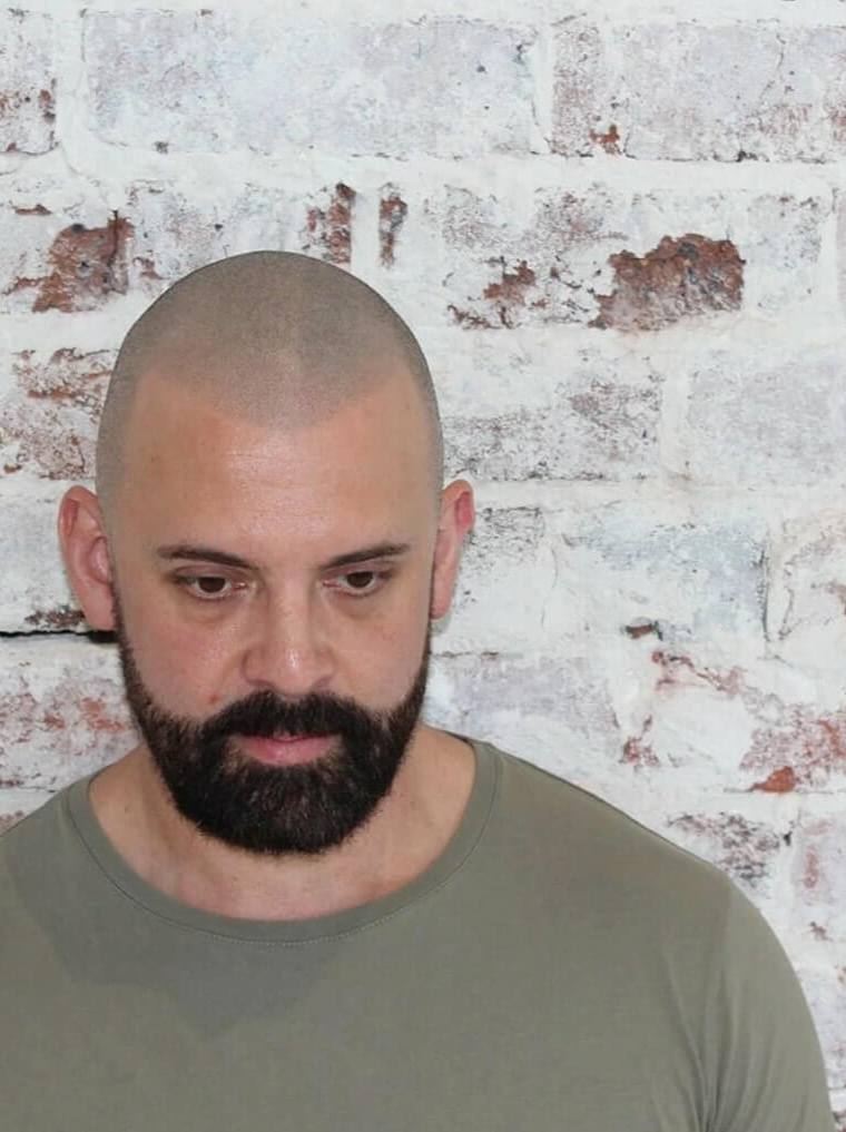 Hair loss and Self Image