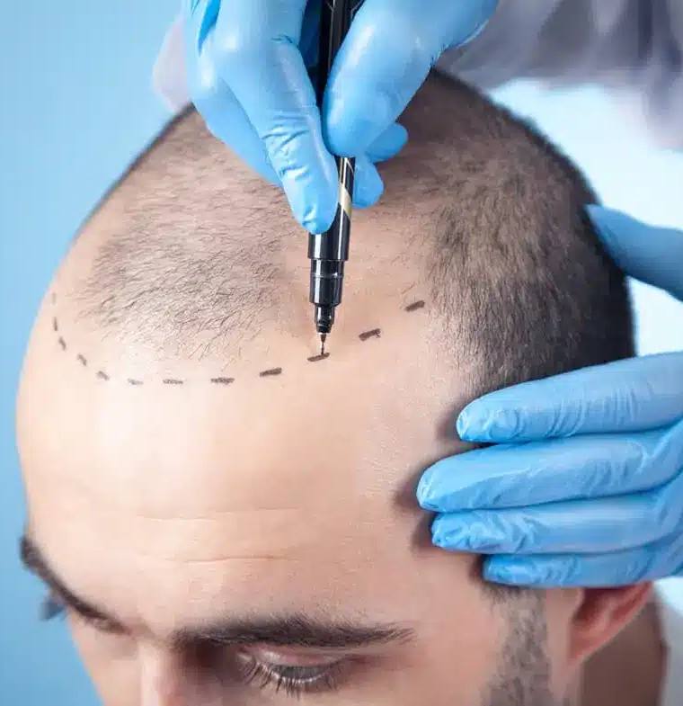 The Latest Hair Loss Treatments To Get Overseas: Why You Should Be Skeptical