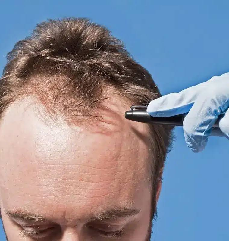 Is the Cure for Hair Loss Coming Soon?