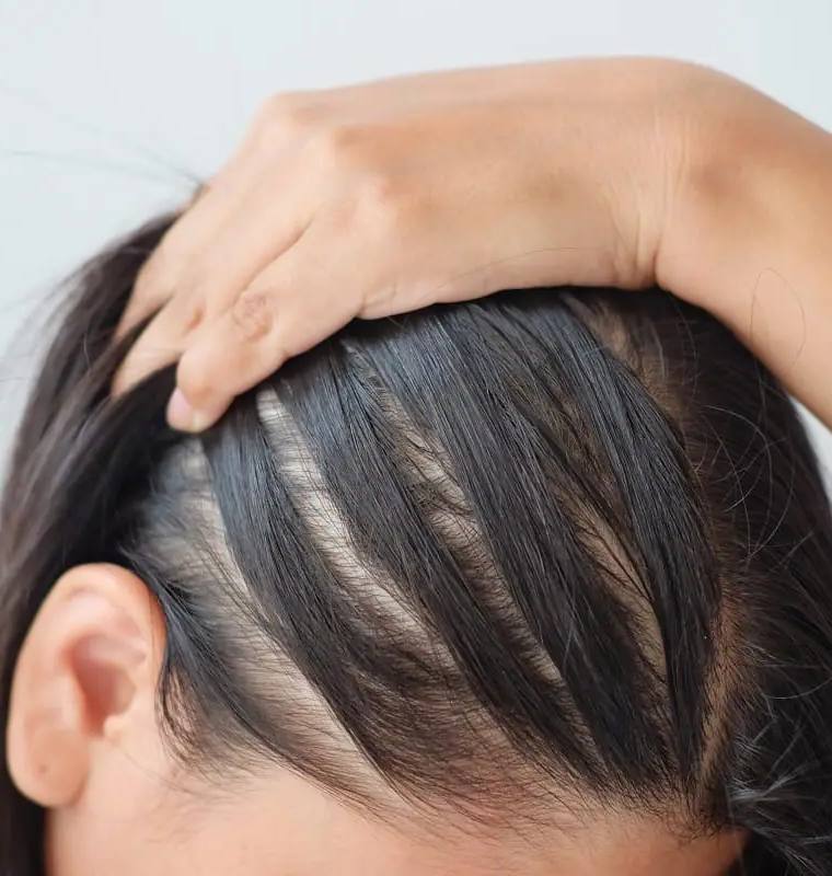 Understanding the Causes of Hair Loss in Women and Effective Ways to Hide Thinning Hair at the Front