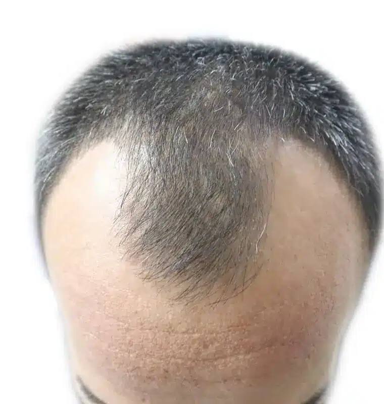 What is an M-Shaped Hairline?