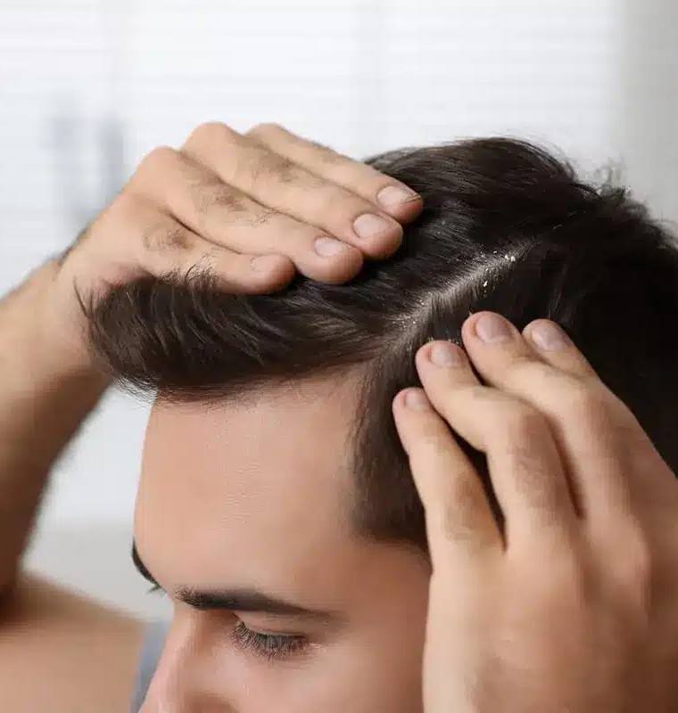 Does Dandruff Cause Hair Loss? Tips to Protect Your Scalp