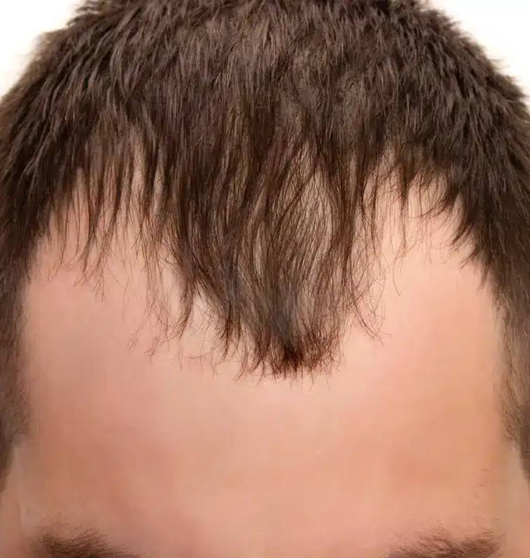 How to Combat a Receding Hairline