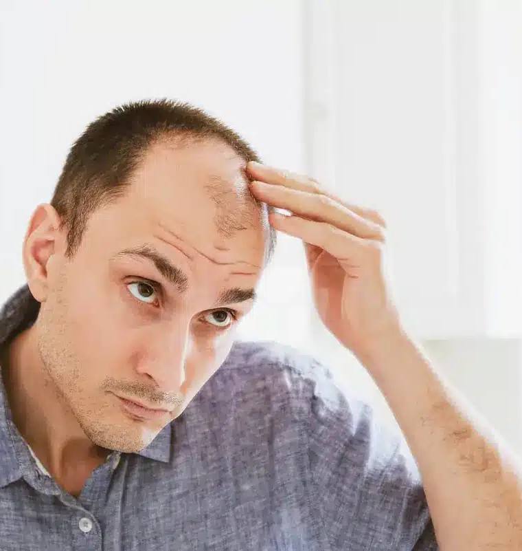A Comprehensive Guide to Understanding Male Pattern Baldness and the Norwood Scale