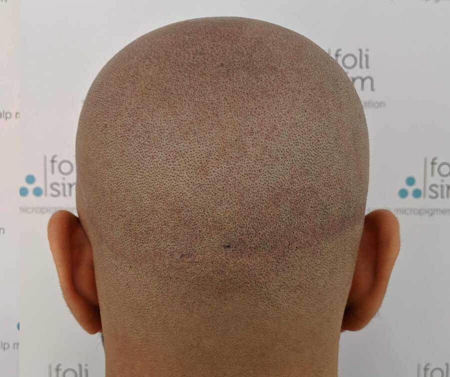 Scalp micropigmentation for scar — after — Foli Sim