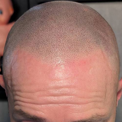 Close-up of a natural hairline created with SMP