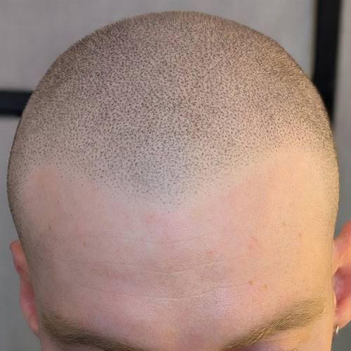 SMP hairline result on a man